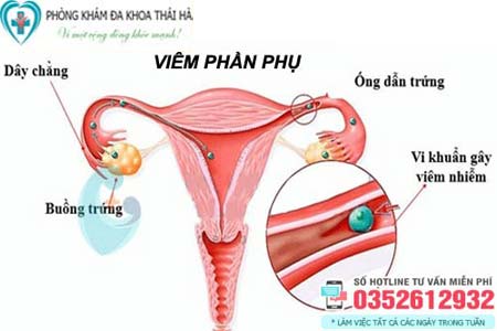 Hình ảnh của viêm phụ khoa do viêm phần phụ
