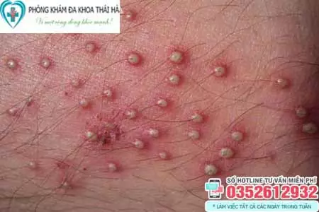 Hình ảnh nổi mụn nhọt ở vùng kín nam