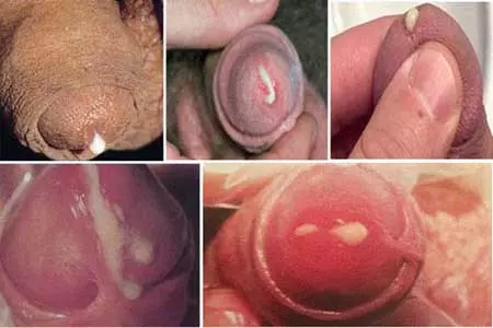 Hình ảnh nổi mụn mủ ở vùng kín nam