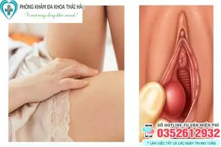 Hình ảnh nổi mụn ở mép vùng kín nữ do u nang Bartholin