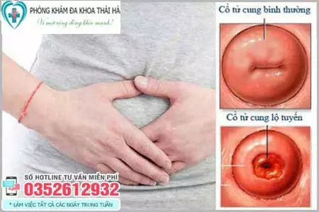 Triệu chứng viêm lộ tuyến cổ tử cung