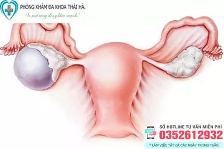 Bệnh u nang buồng trứng