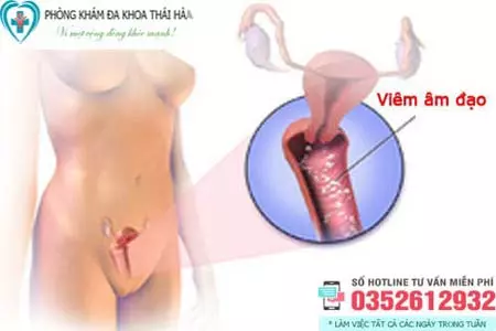 Cách chữa viêm âm đạo