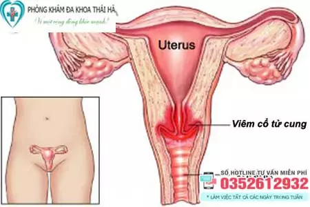 Cách chữa viêm cổ tử cung