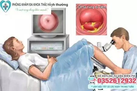 Điều trị viêm cổ tử cung