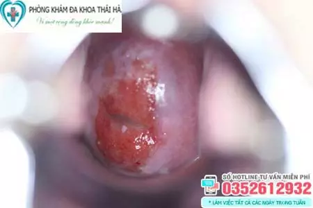 Hình ảnh viêm lộ tuyến cổ tử cung độ 2