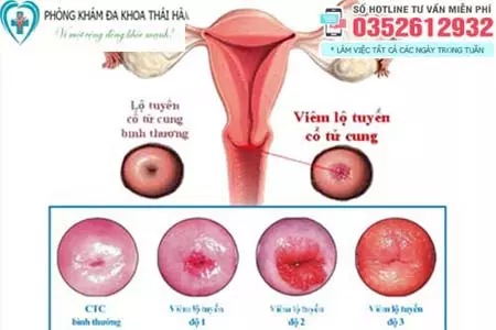 Viêm lộ tuyến cổ tử cung độ 3 có nguy hiểm không