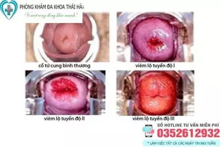 Hình ảnh viêm lộ tuyến cổ tử cung qua các cấp độ