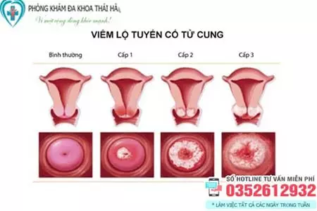 Điều trị viêm lộ tuyến cổ tử cung độ 3