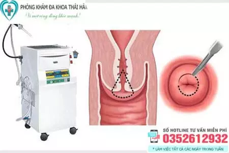 Điều trị viêm lộ tuyến cổ tử cung bằng dao LEEP
