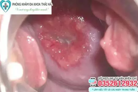 Hình ảnh viêm lộ tuyến cổ tử cung độ 3