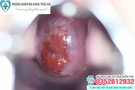 Hình ảnh bệnh viêm lộ tuyến cổ tử cung cấp độ 3