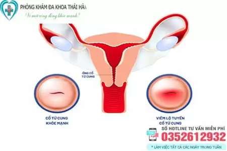 Chữa viêm lộ tuyến cổ tử cung ở đâu tốt