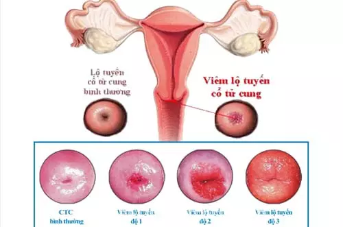 Viêm lộ tuyến cổ tử cung là gì