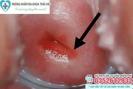Hình ảnh viêm lộ tuyến cổ tử cung độ 1