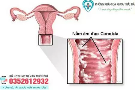 Dấu hiệu viêm âm đạo do nấm Candida