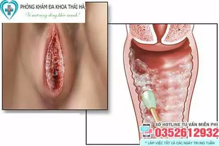 Hình ảnh viêm âm đạo do nấm Candida
