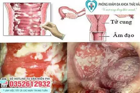 Hình ảnh âm đạo bị viêm do Candida