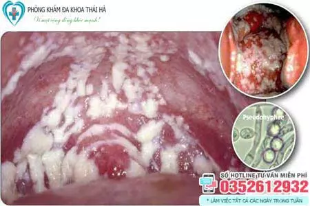 Hình ảnh nấm âm đạo Candida