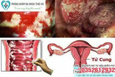 Viêm nấm âm đạo Candida