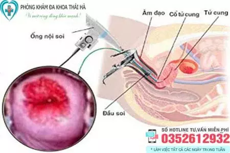 Chi phí đốt viêm lộ tuyến cổ tử cung bao nhiêu tiền