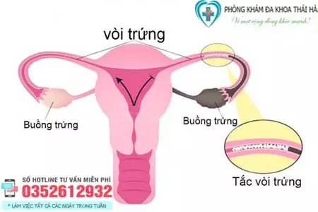 Tắc vòi trứng