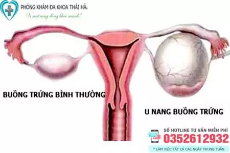 Nguyên nhân tại sao bị u nang buồng trứng