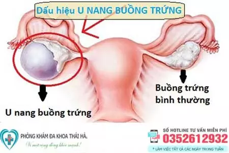 Dấu hiệu u nang buồng trứng