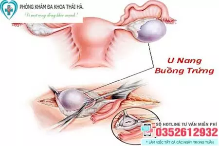 Mổ u nang buồng trứng