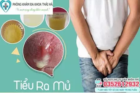 Đi tiểu buốt ra mủ ở nam giới
