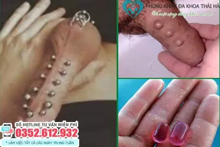 Địa chỉ tháo bi dương vật ở Hà Nội
