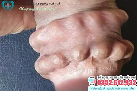 Chi phí tháo bi dương vật bao nhiêu tiền