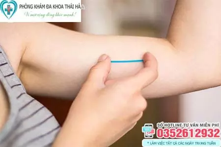 Cấy que tránh thai