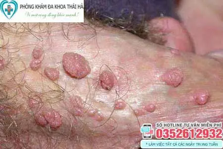 Dấu hiệu sùi mào gà ở nam giới