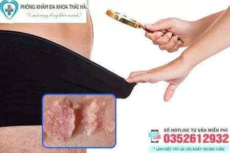 Sùi mào gà ở nam thường mọc ở đâu