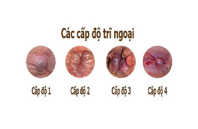 Cách chữa bệnh trĩ ngoại