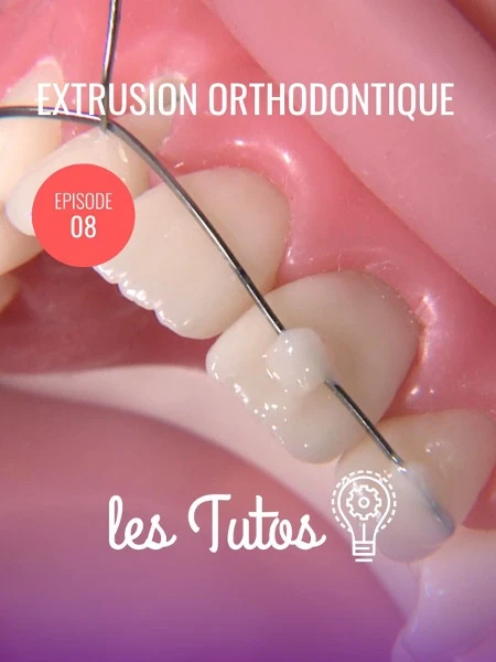 Esmile Academy's "Tutorials" Series, Episode 8: Orthodontic Extrusion