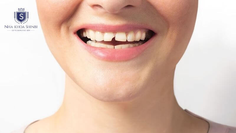 Bọc răng sứ dành cho những người răng bị ố, mẻ,...