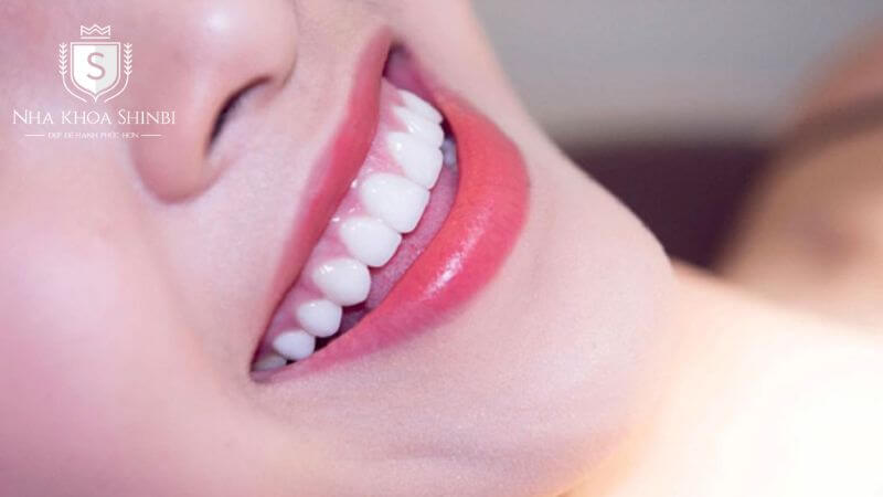 Các loại răng sứ Zirconia phổ biến