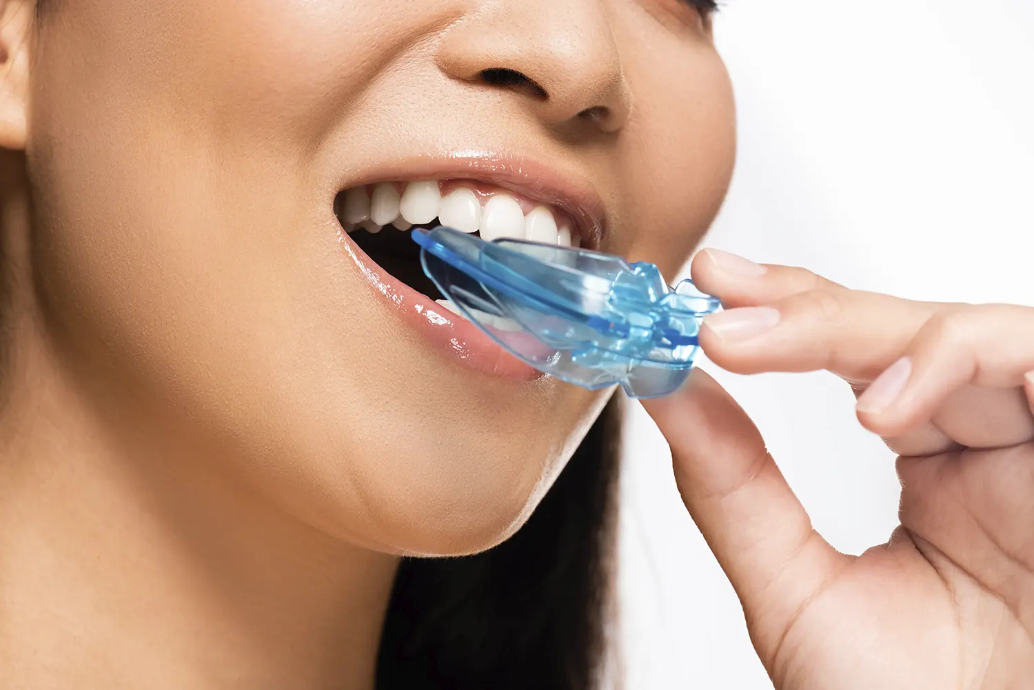 Benefits of Custom Mouth Guards Over Store-Bought Devices