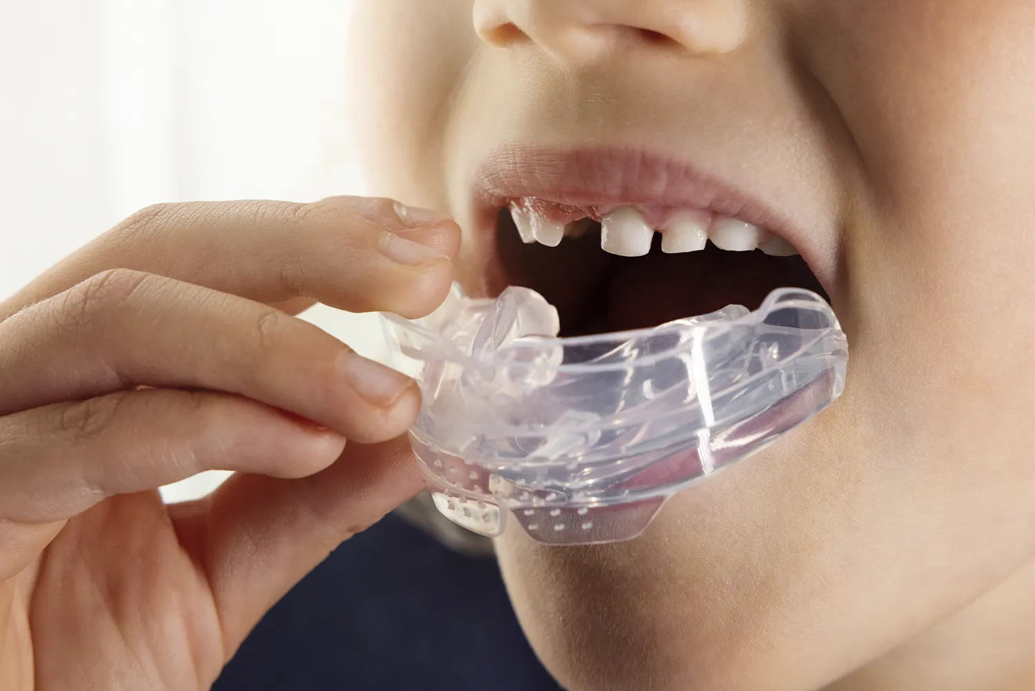 Mouth Breathing Fix: Myobrace for Pediatric Airway Health Mouth Breathing Fix: Myobrace for Pediatric Airway Health