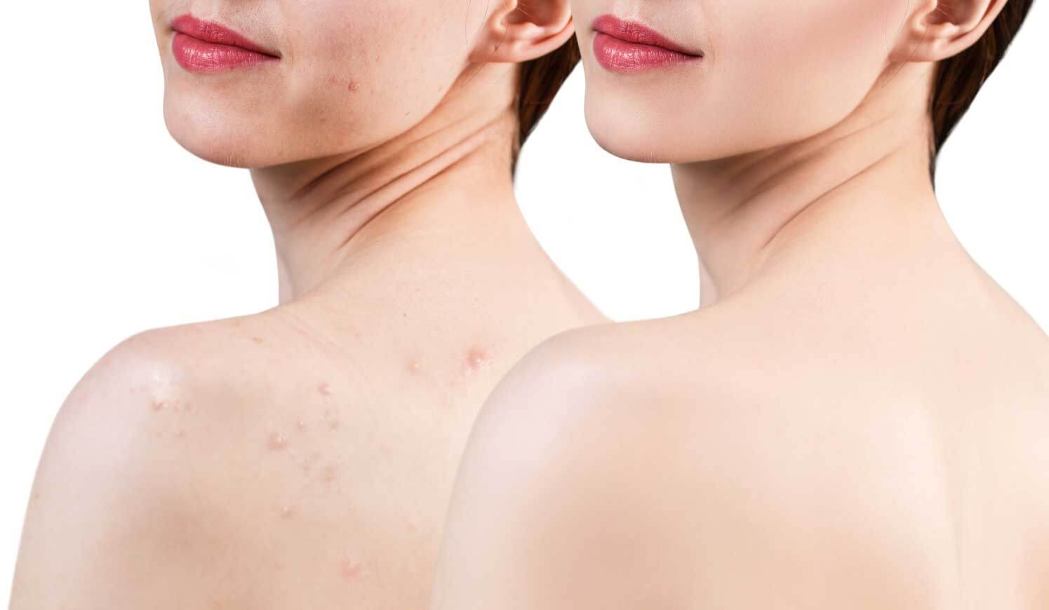 EnerPeel® Salicylic Acid Chest & Back