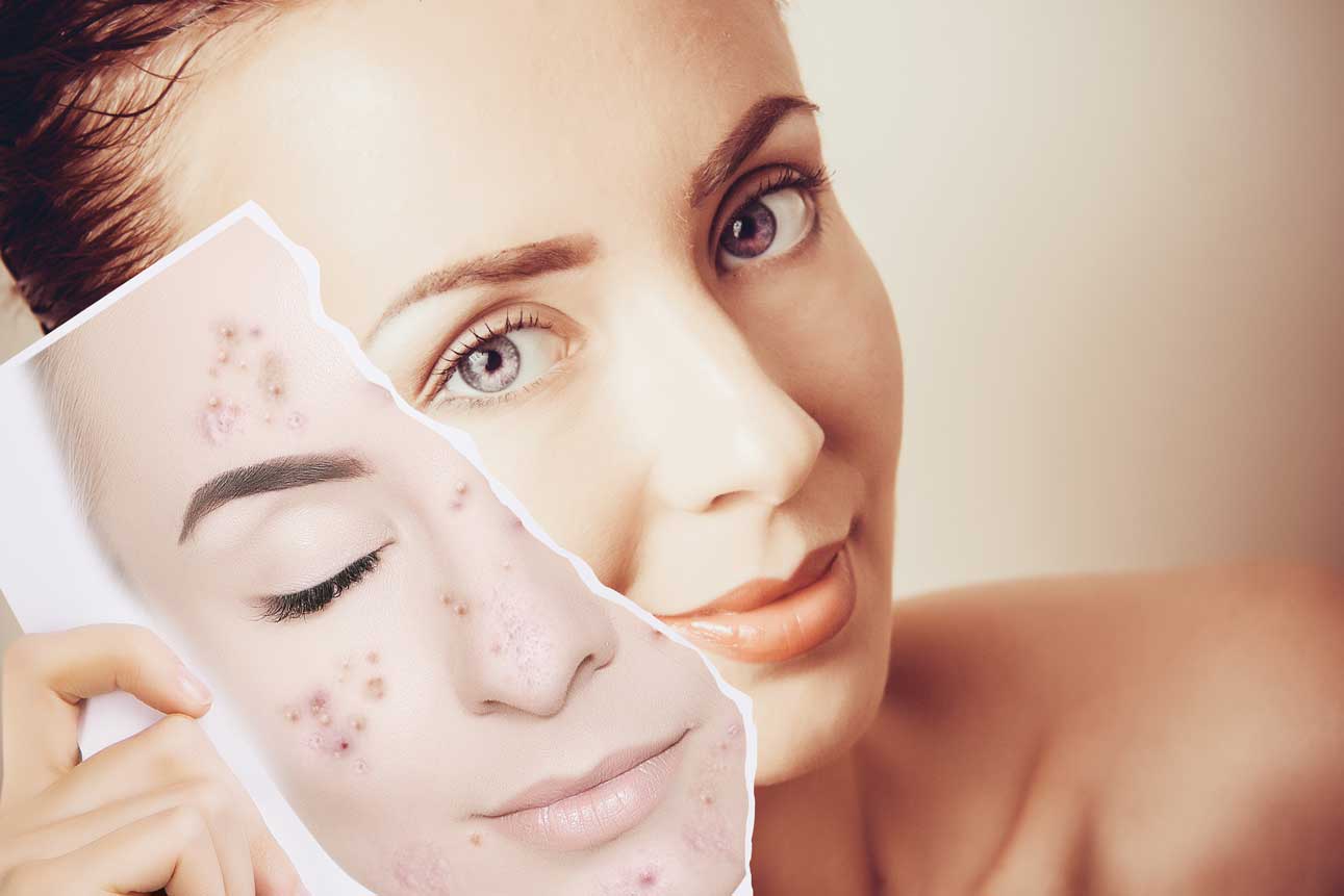 EnerPeel® Salicylic Acid