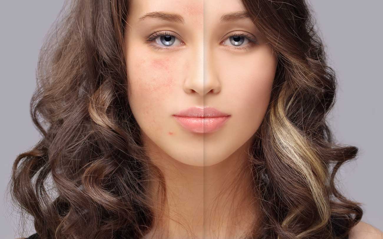 Enerpeel® Jessners