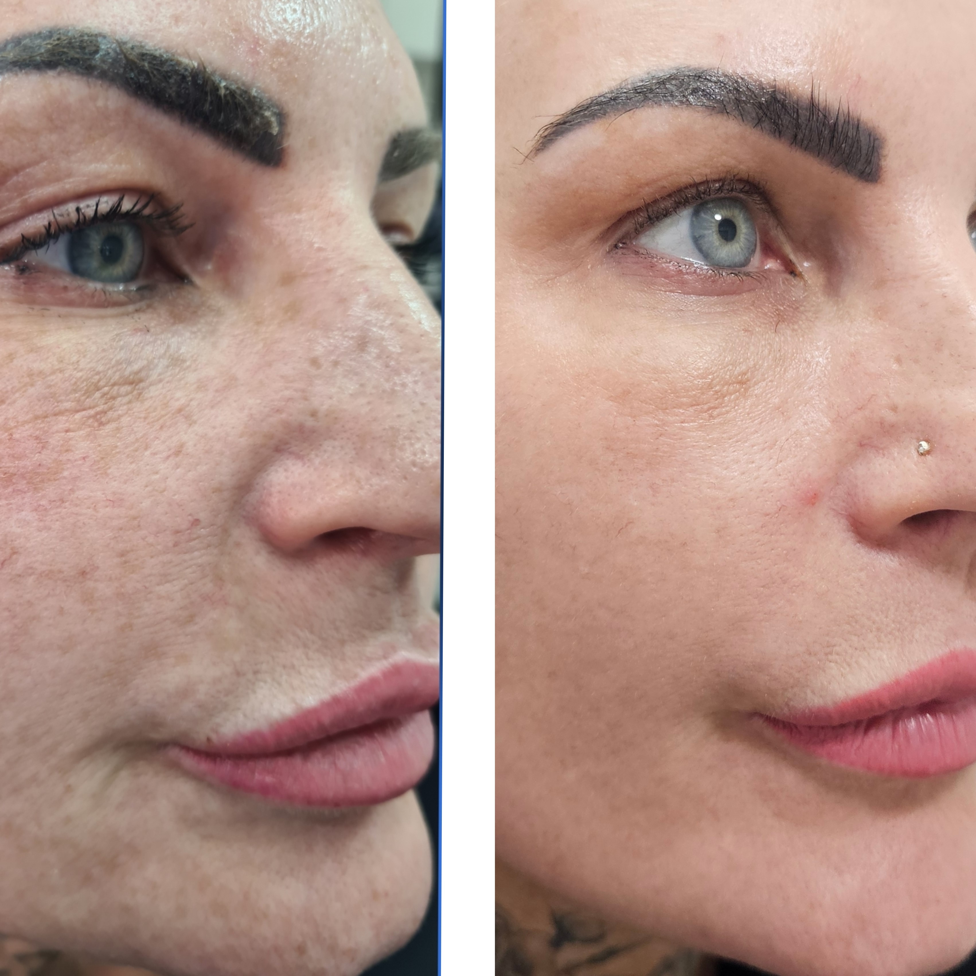 Perfect Time to Get Co2 Fractional Treatments