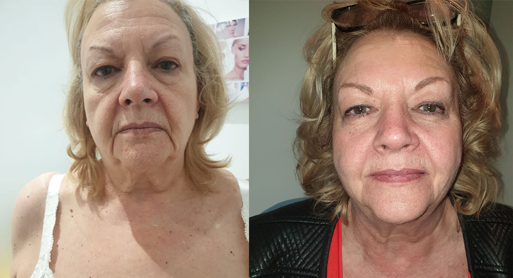 hifu facelift before and after