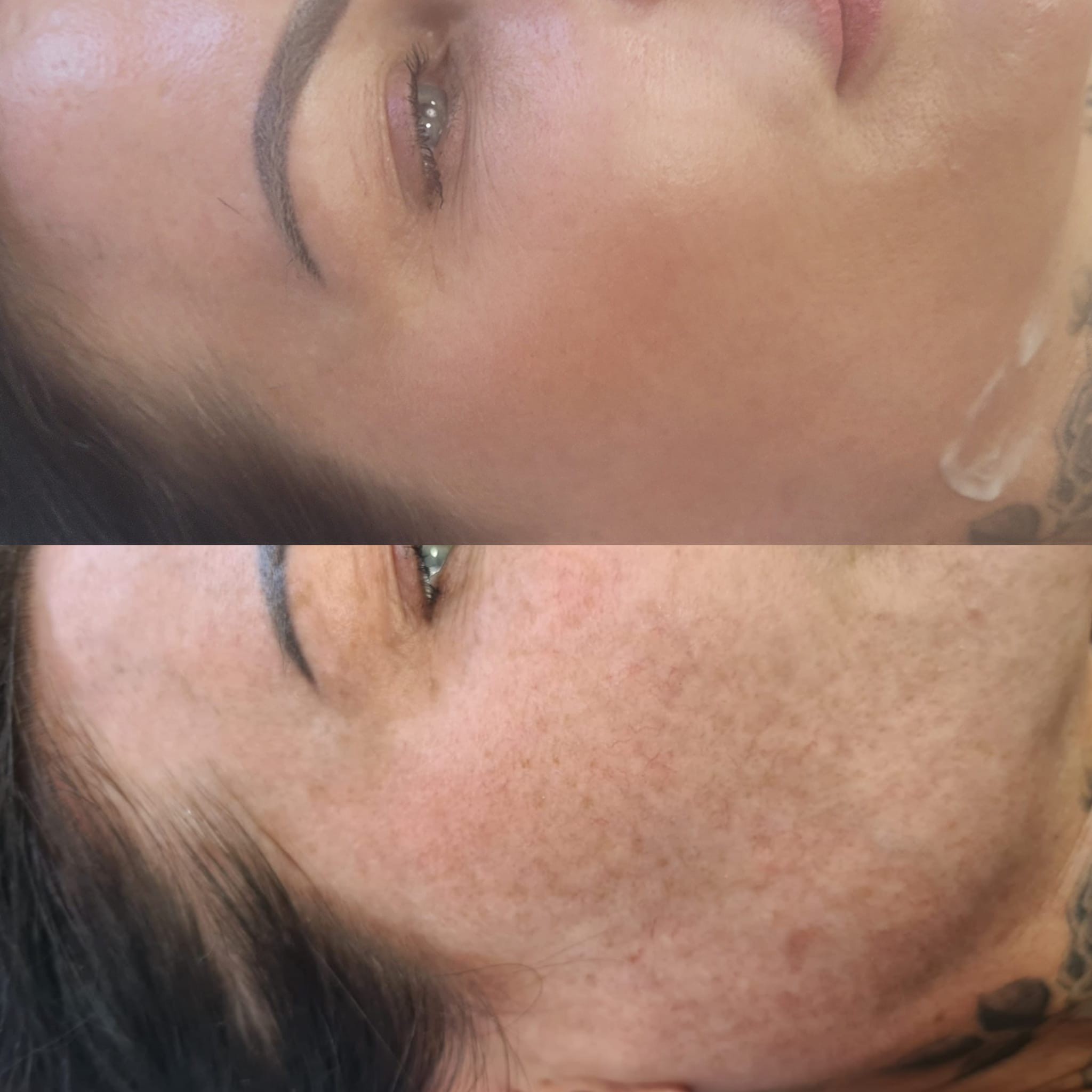 Renew, Restore, Reveal: Advanced Skin Resurfacing with CO₂ Fractional Laser