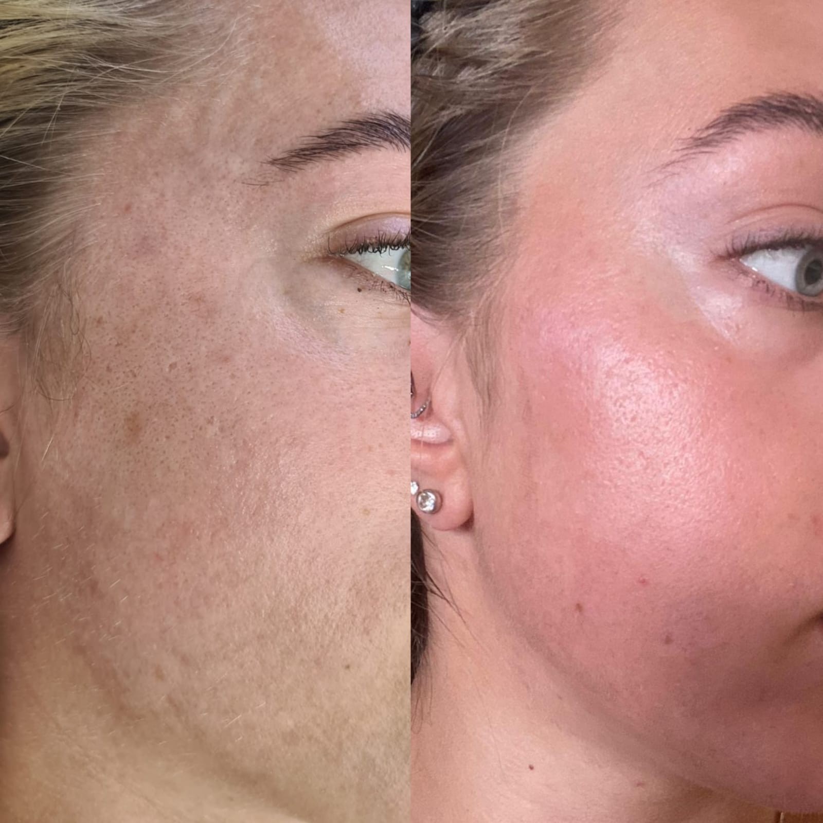 C02 Fractional Laser Skin Resurfacing
