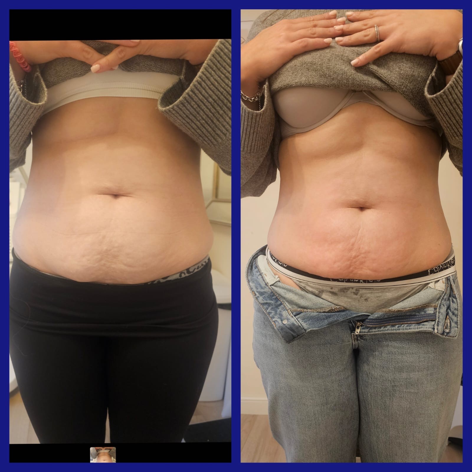 The Truth About Stubborn Fat – And Why Fat Freeze 360 Is A Game Changer