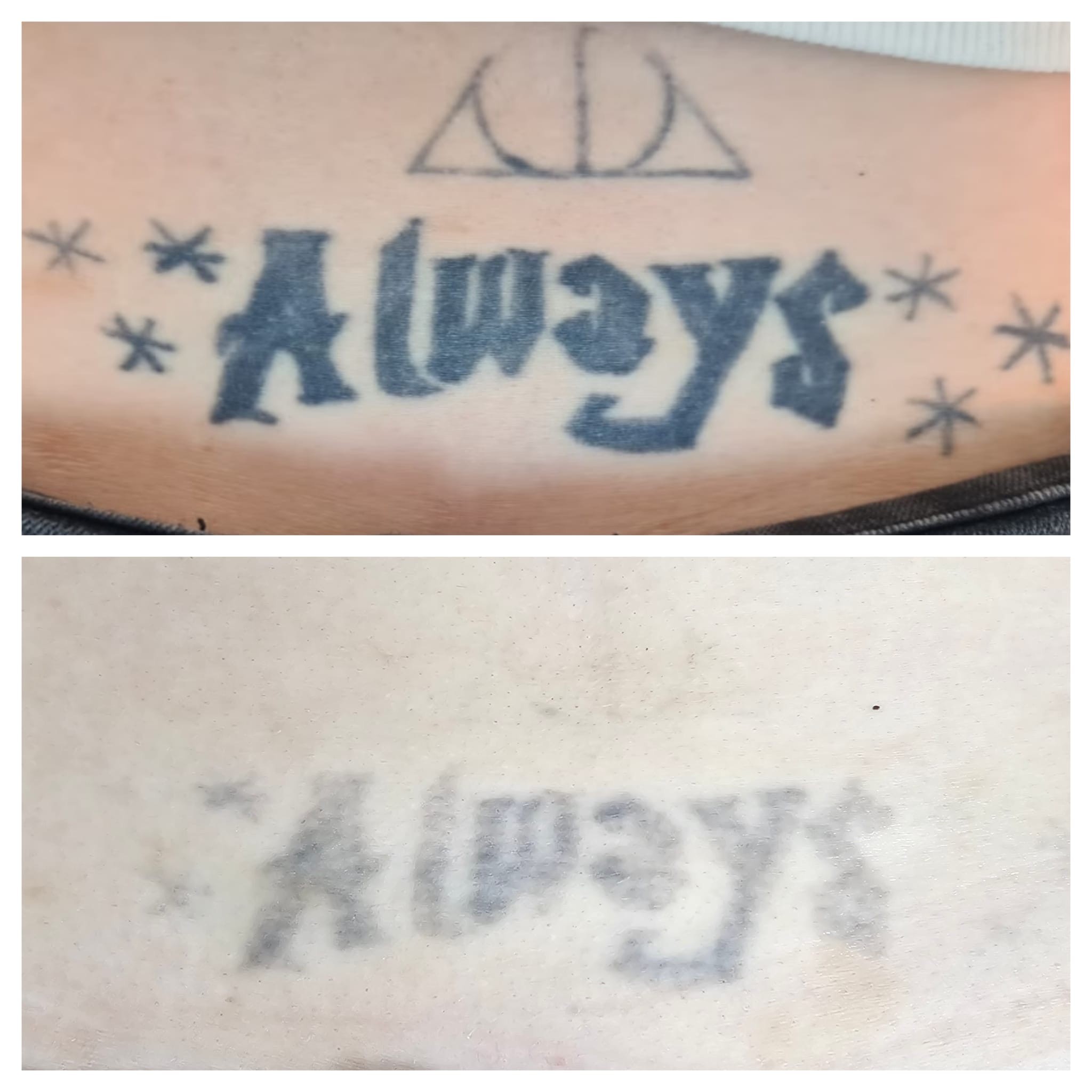 Tattoo Removal: What You Should Actually Expect